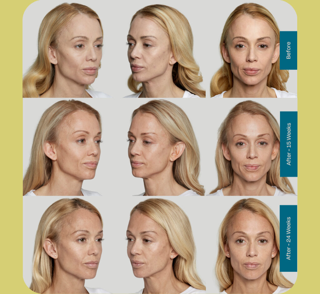 Sculptra Treatments